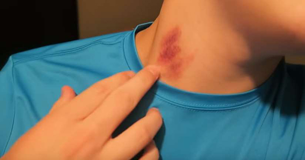 Hickey.PNG
